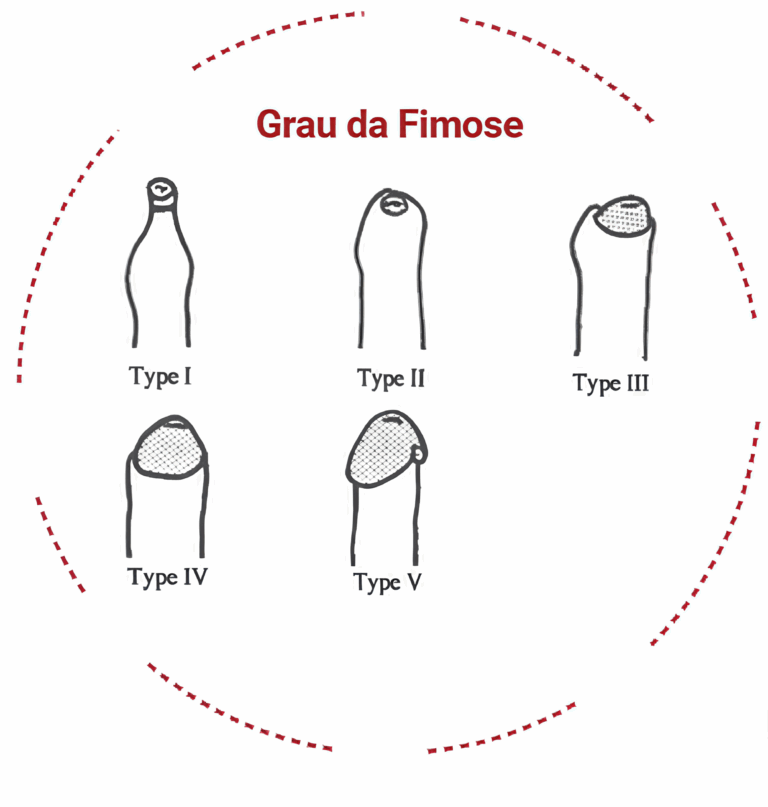 Fimose O Que Quando E Como Tratar Dr Ant nio Soares Urologista fimose-o-que-quando-e-como-tratar-dr-ant-nio-soares-urologista